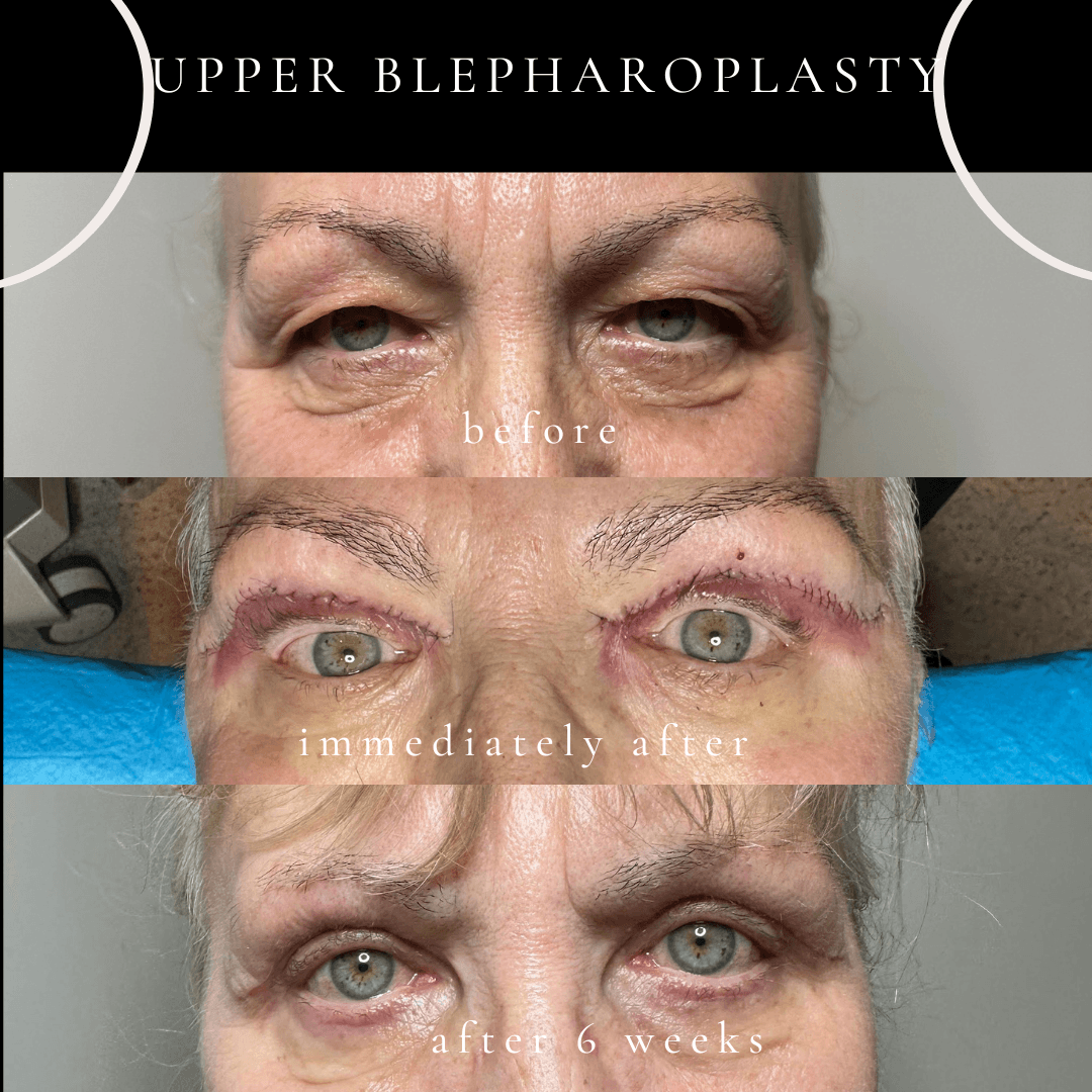 Before, 1-week, and 6-week after photos of upper blepharoplasty performed under local anaesthesia to correct heavy, drooping eyelids and restore a rejuvenated appearance.