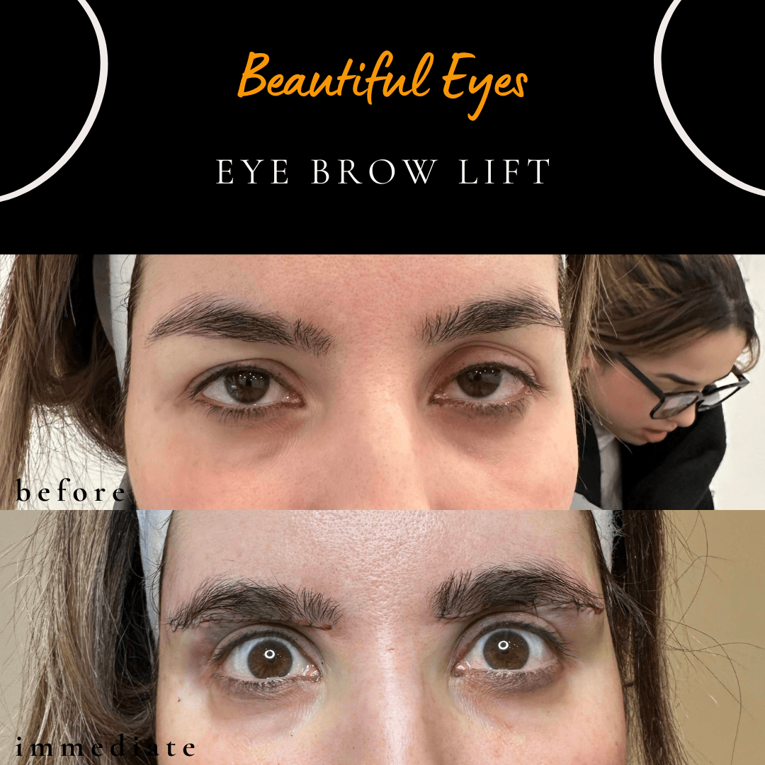 Sub-brow lift performed under local anaesthesia to lift heavy upper eyelid skin and achieve natural eyelid rejuvenation by Dr Peter Kim.