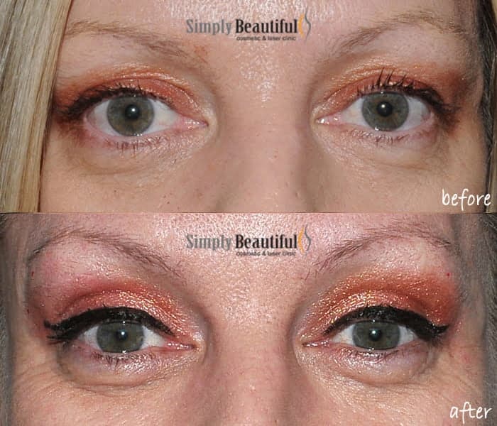 cosmetic upper eyelid blepharoplasty surgery dr peter kim