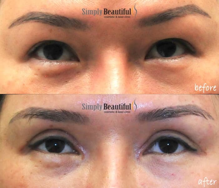 Before and after double eyelid surgery creating a defined upper eyelid crease by Dr Peter Kim in Sydney. Before and after double eyelid surgery creating a defined upper eyelid crease by Dr Peter Kim in Sydney.