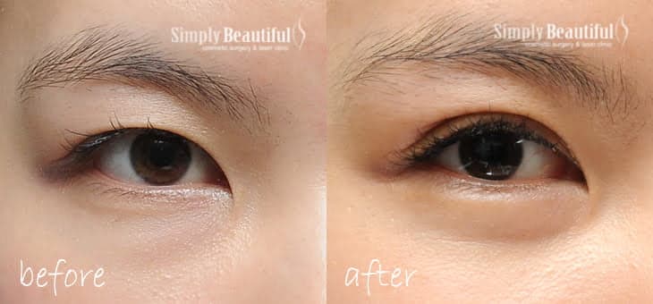 Before and after non-surgical double eyelid creation with threads in a young Asian patient with a monolid. Before and after non-surgical double eyelid creation with threads in a young Asian patient with a monolid.