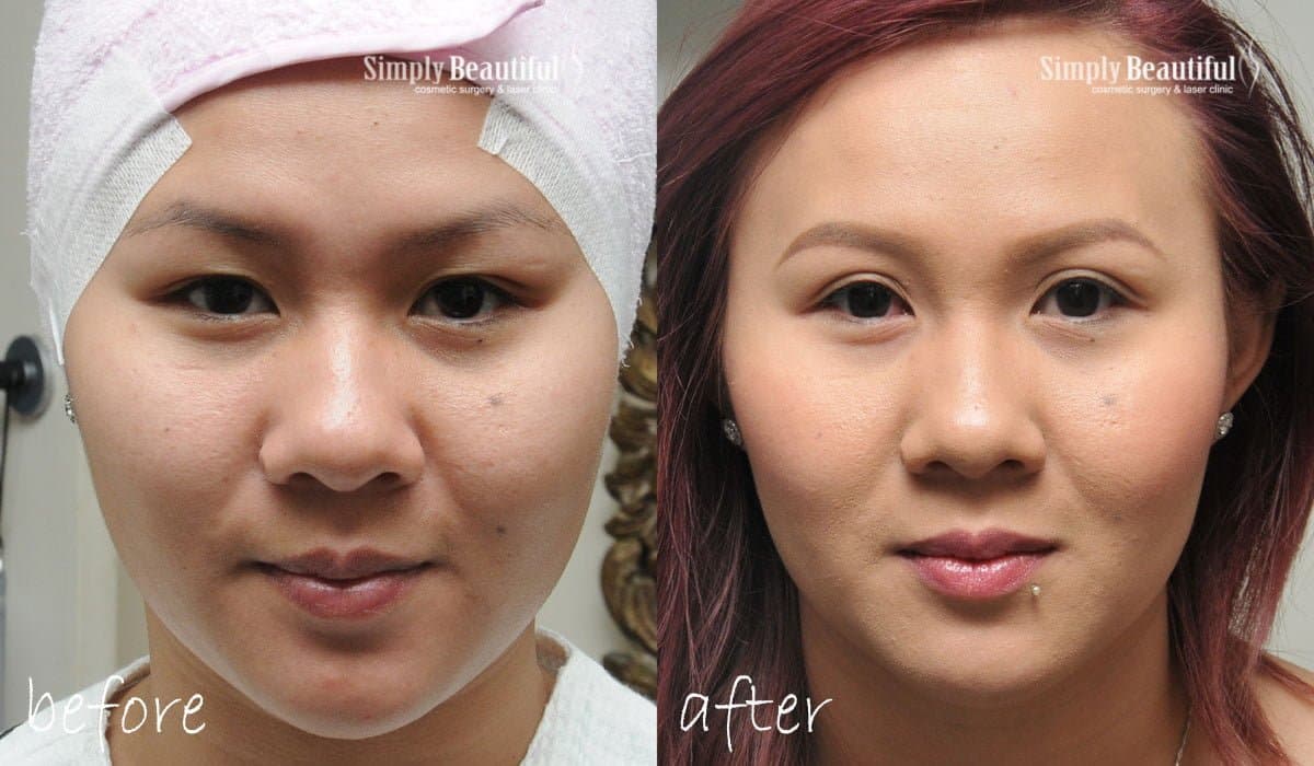 Before and after non-surgical double eyelid threads by Dr Peter Kim — featured case 1 Before and after non-surgical double eyelid threads by Dr Peter Kim — featured case 1