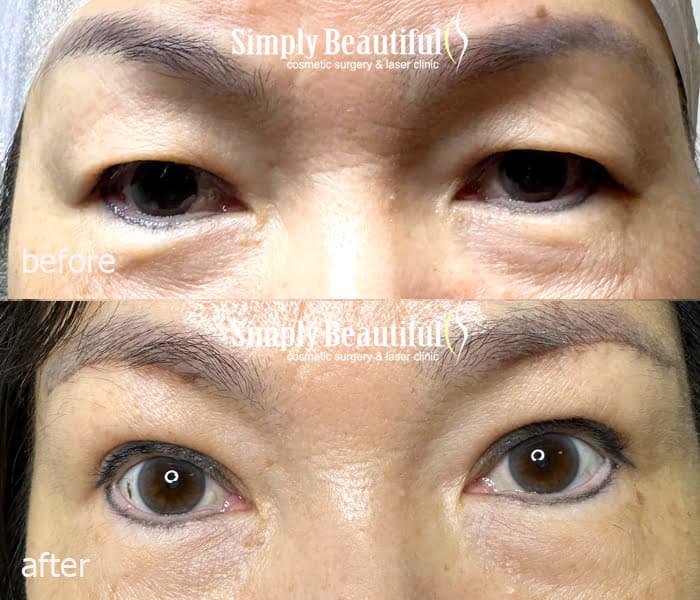 Korean style double eyelids achieved with sub-brow lift and double eyelid sutures by Dr Peter Kim. Korean style double eyelids achieved with sub-brow lift and double eyelid sutures by Dr Peter Kim.
