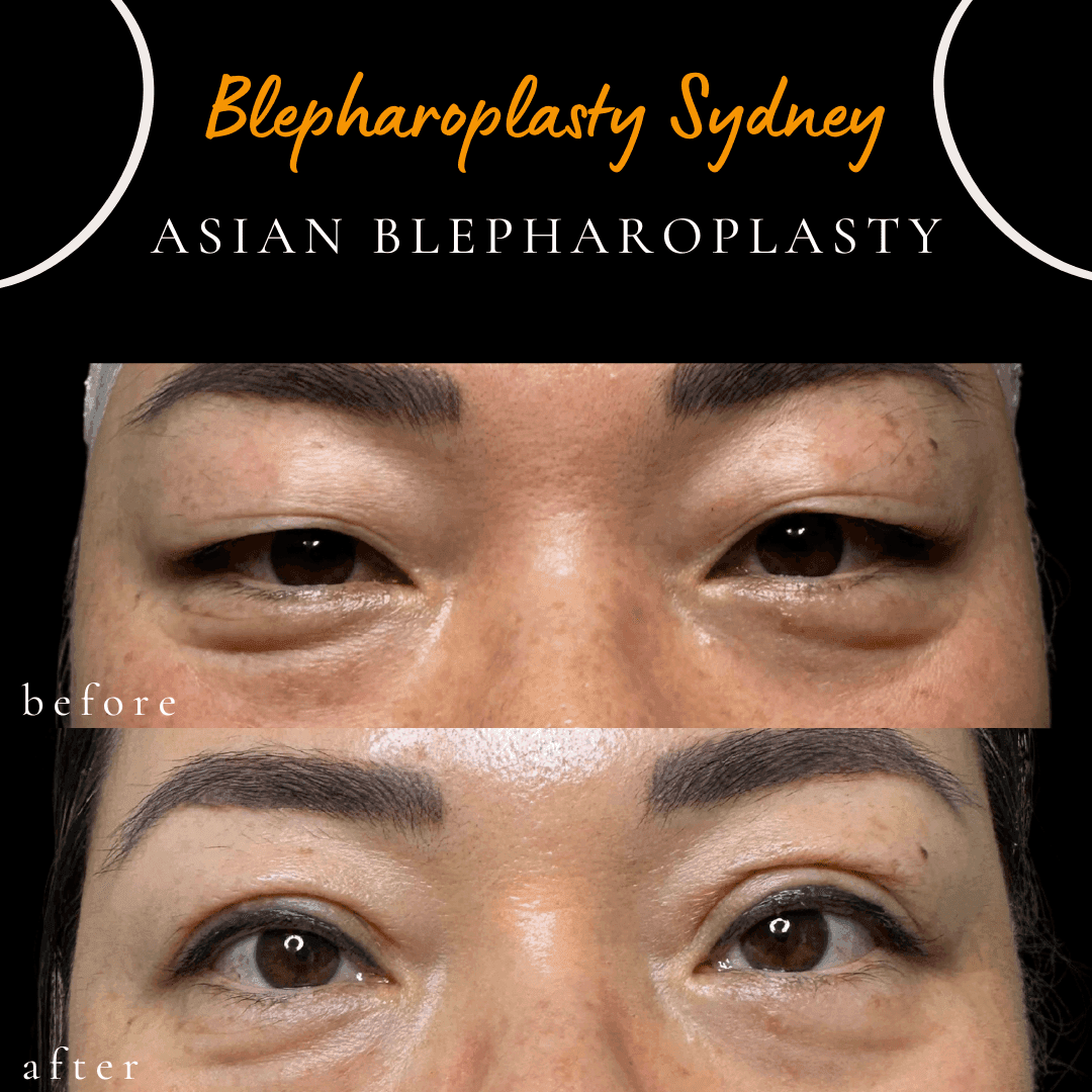 Six weeks after Asian blepharoplasty by Dr Peter Kim in Sydney. Six weeks after Asian blepharoplasty by Dr Peter Kim in Sydney.