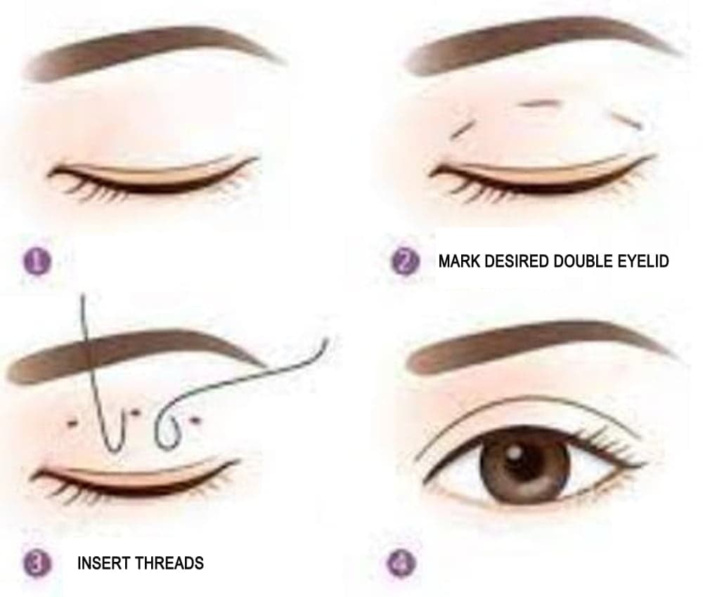 Marking the desired double eyelid shape on the upper eyelid before placing threads. Marking the desired double eyelid shape on the upper eyelid before placing threads.