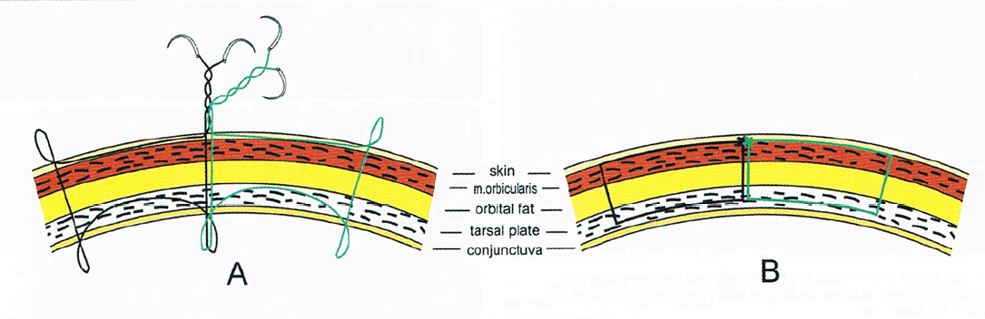 Diagram of thread placement for non-surgical double eyelid creation, published in the American Journal of Cosmetic Surgery. Diagram of thread placement for non-surgical double eyelid creation, published in the American Journal of Cosmetic Surgery.