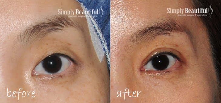 Comparison photo of a monolid and a double eyelid by Dr Peter Kim. Comparison photo of a monolid and a double eyelid by Dr Peter Kim.