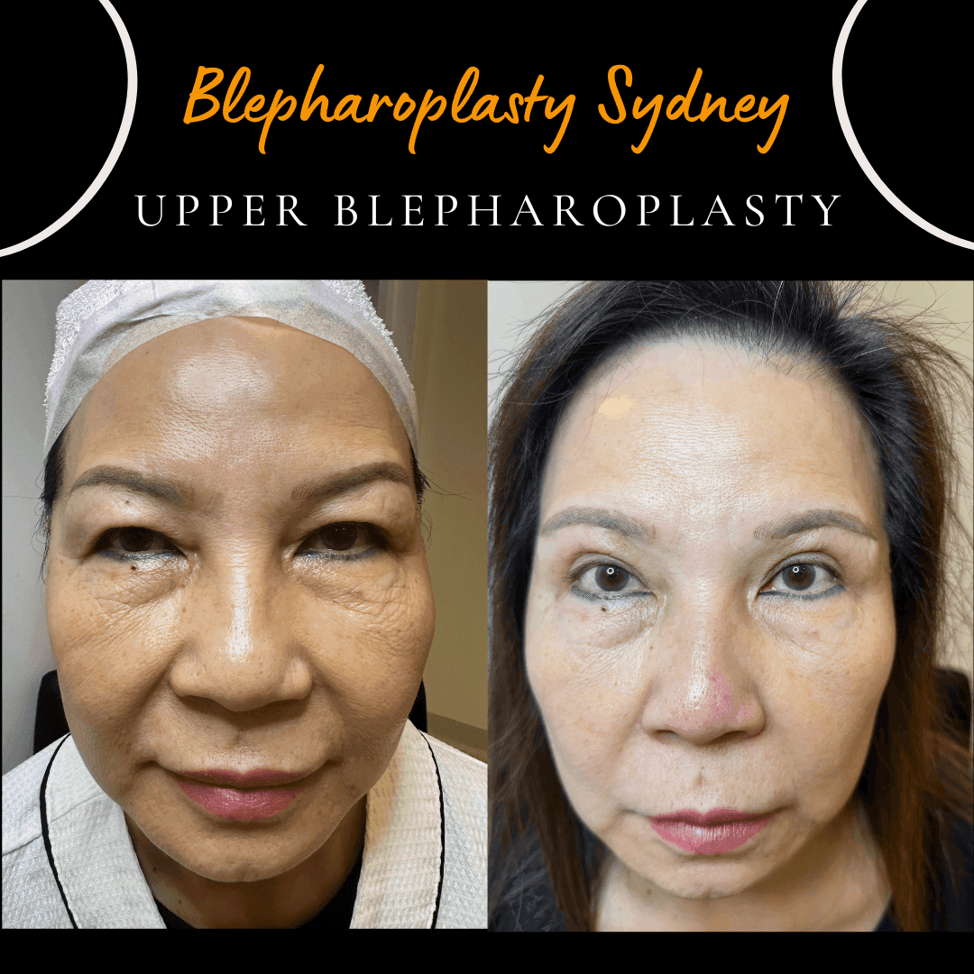 Six weeks after combined Asian blepharoplasty and sub-brow lift by Dr Peter Kim. Six weeks after combined Asian blepharoplasty and sub-brow lift by Dr Peter Kim.