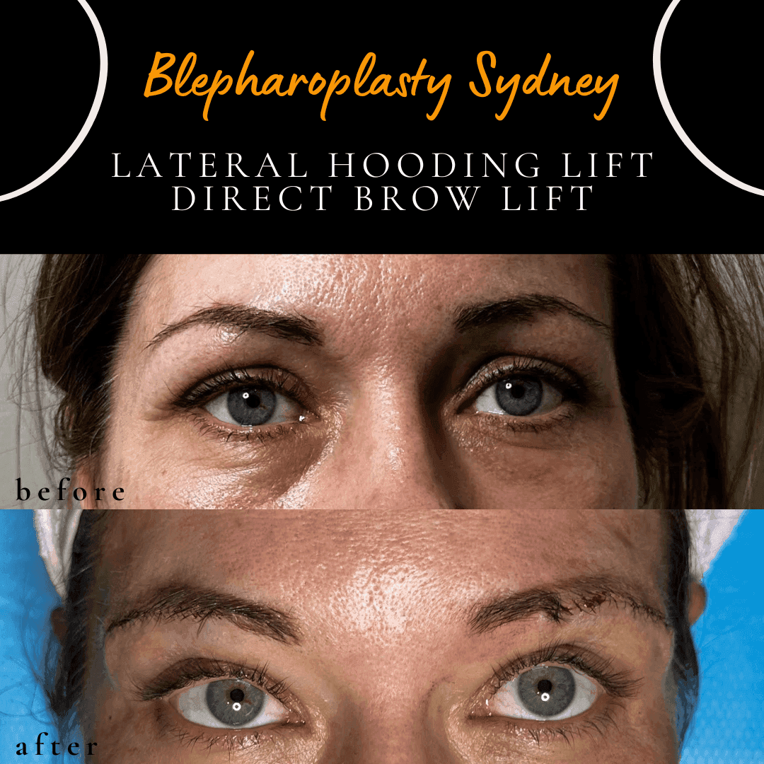 Before and after lateral hooding correction with sub-brow lift by Dr Peter Kim. Before and after lateral hooding correction with sub-brow lift by Dr Peter Kim.