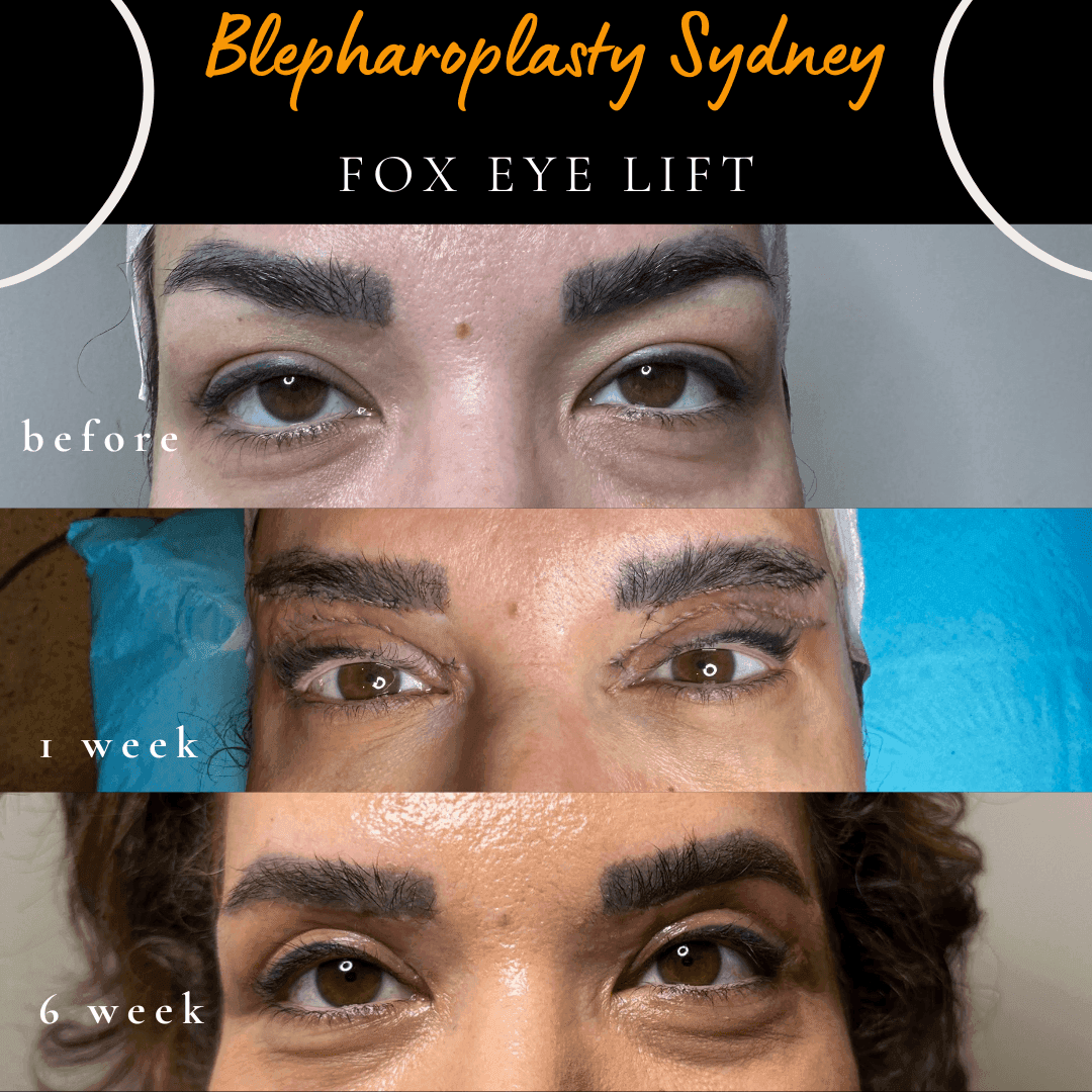 Immediate and six-week healing after upper blepharoplasty and sub-brow lift (Fox Eye Lift). Immediate and six-week healing after upper blepharoplasty and sub-brow lift (Fox Eye Lift).