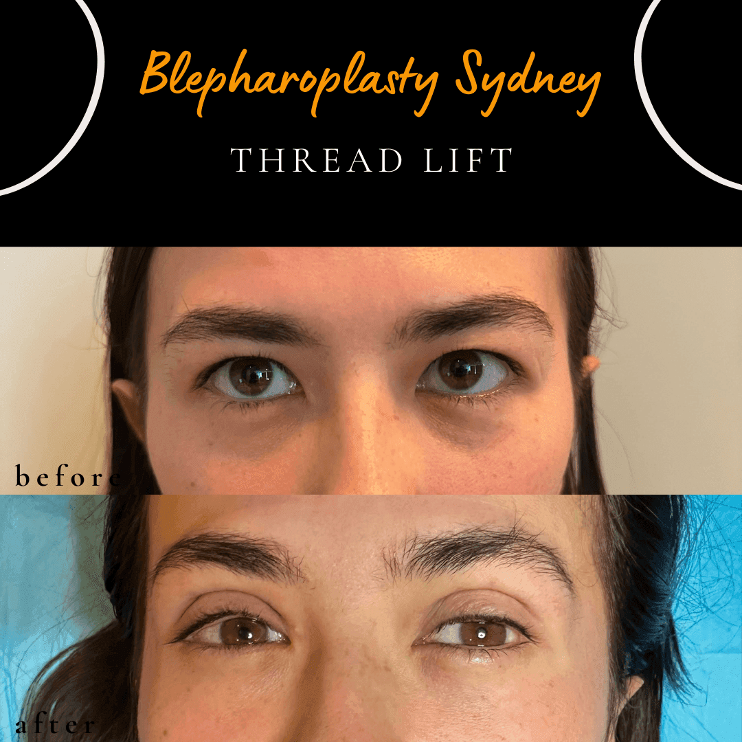 Immediately after a non-surgical upper eyelid thread lift by Dr Peter Kim. Immediately after a non-surgical upper eyelid thread lift by Dr Peter Kim.