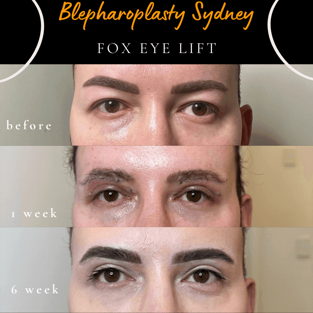 Before, one week and six weeks after a fox eye lift with sub-brow lift and upper blepharoplasty by Dr Peter Kim. Before, one week and six weeks after a fox eye lift with sub-brow lift and upper blepharoplasty by Dr Peter Kim.