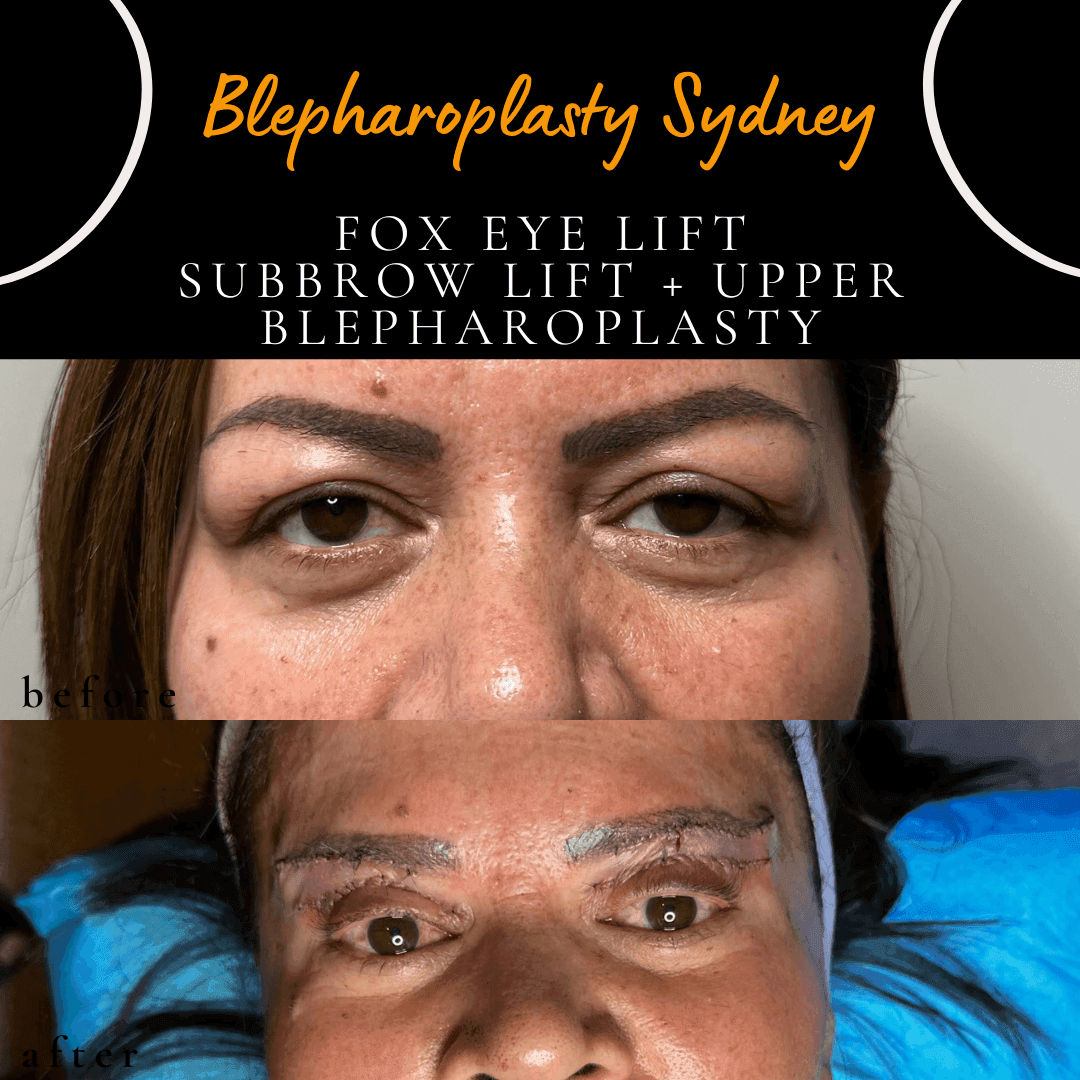 Before and immediately after combined Fox Eye Lift procedures by Dr Peter Kim. Before and immediately after combined Fox Eye Lift procedures by Dr Peter Kim.