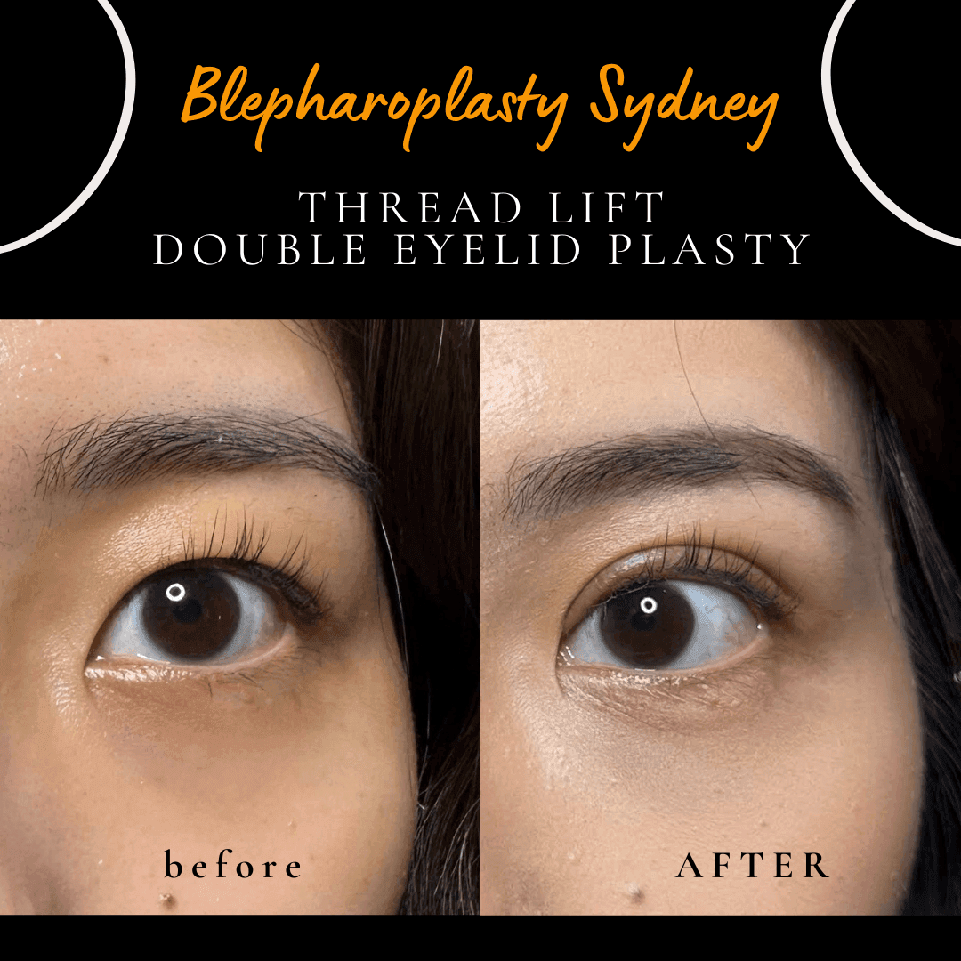 One week after a non-surgical thread lift to create Asian double eyelids by Dr Peter Kim. One week after a non-surgical thread lift to create Asian double eyelids by Dr Peter Kim.