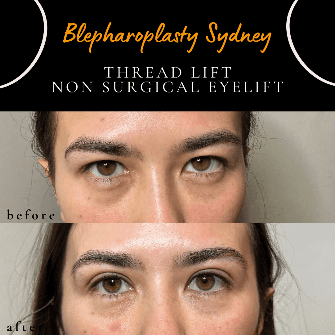 Before and after double eyelids created with the Durable Suture Technique thread lift by Dr Peter Kim. Before and after double eyelids created with the Durable Suture Technique thread lift by Dr Peter Kim.