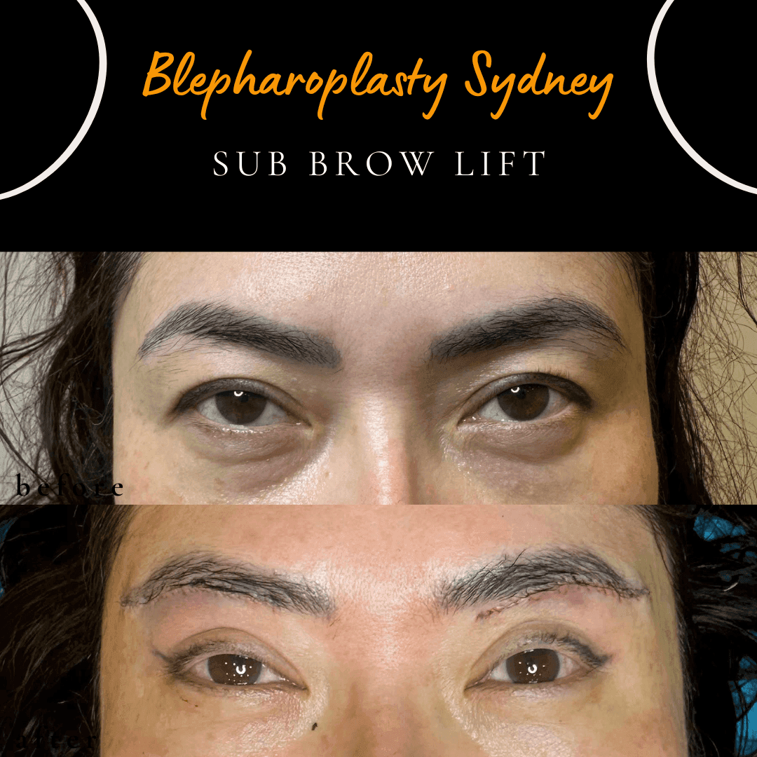 Before and after a fox eye lift achieved with a stand-alone sub-brow lift by Dr Peter Kim. Before and after a fox eye lift achieved with a stand-alone sub-brow lift by Dr Peter Kim.