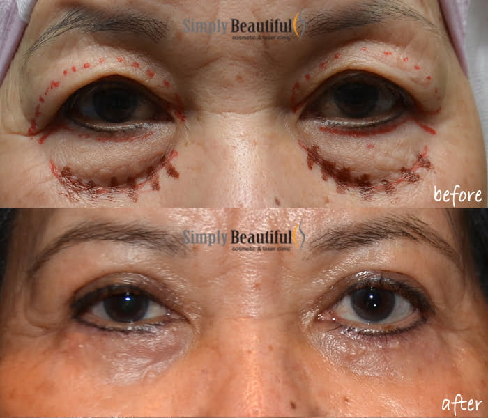 Lower eyelid deals surgery recovery