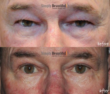 cosmetic upper eyelid blepharoplasty surgery dr peter kim