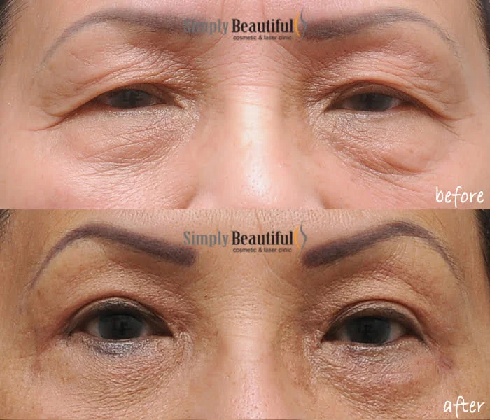 Lower eyelid blepharoplasty surgery - Cosmetic Blepharoplasty Sydney - Dr  Peter Kim