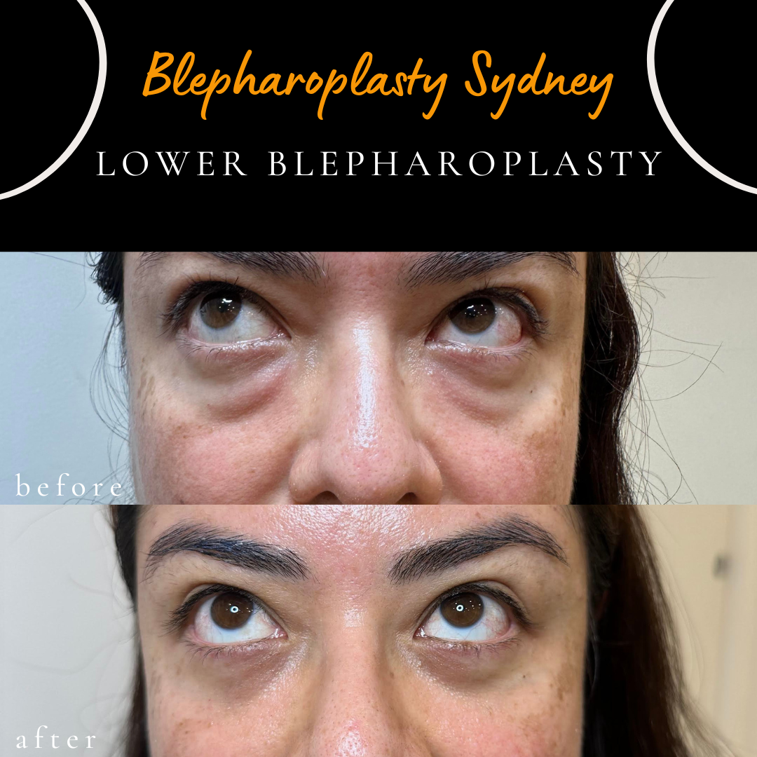 before after lower blepharoplasty scar less eyebag correction surgery sydney dr peter kim