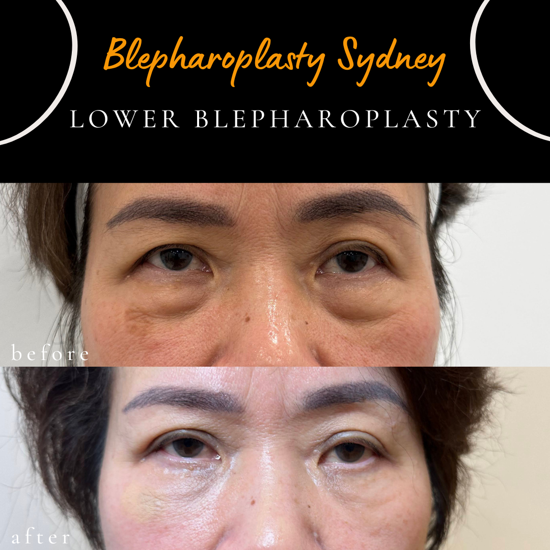 before and after photo following lower blepharoplasty by dr peter kim in blepharoplasty sydney clinic.