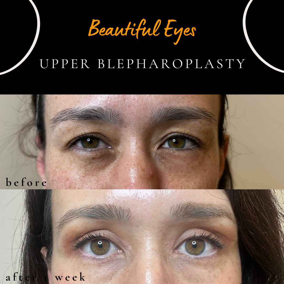 before and after photo after upper blepharoplasty sydney for eurasian type of eyelid
