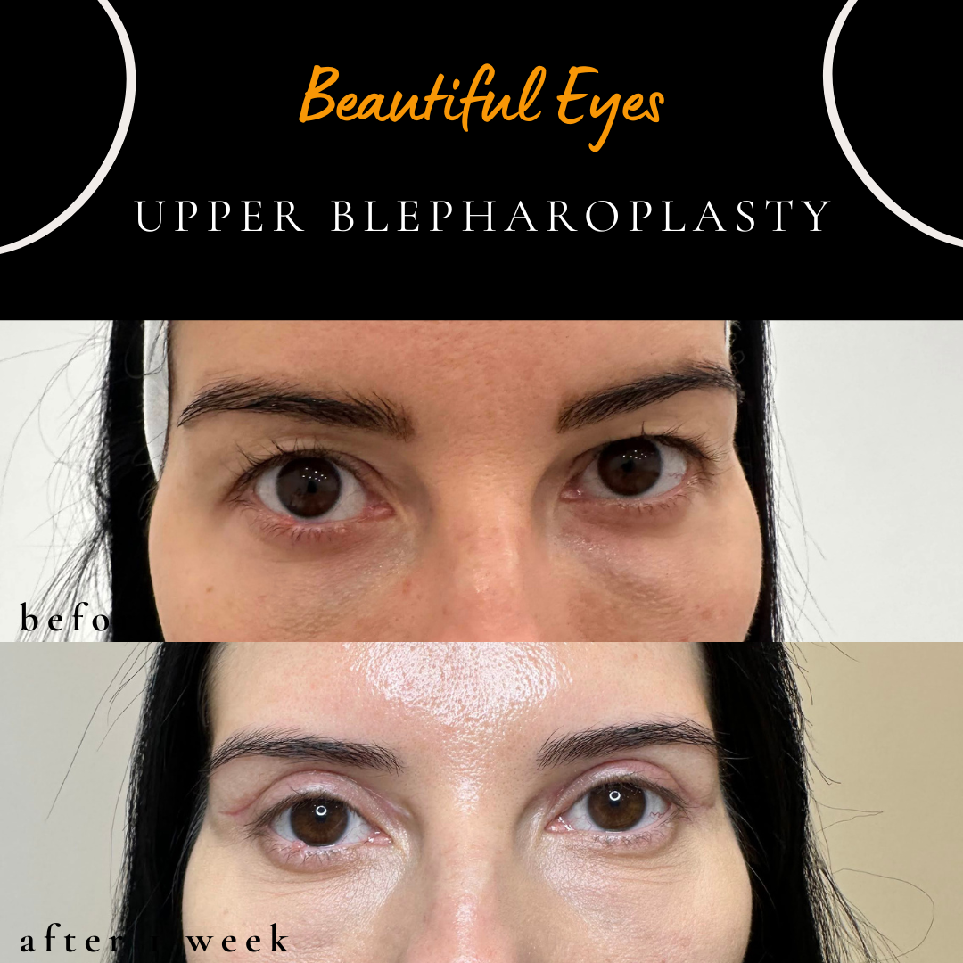 before after photo upper blepharoplasty young lebanese middle eastern woman