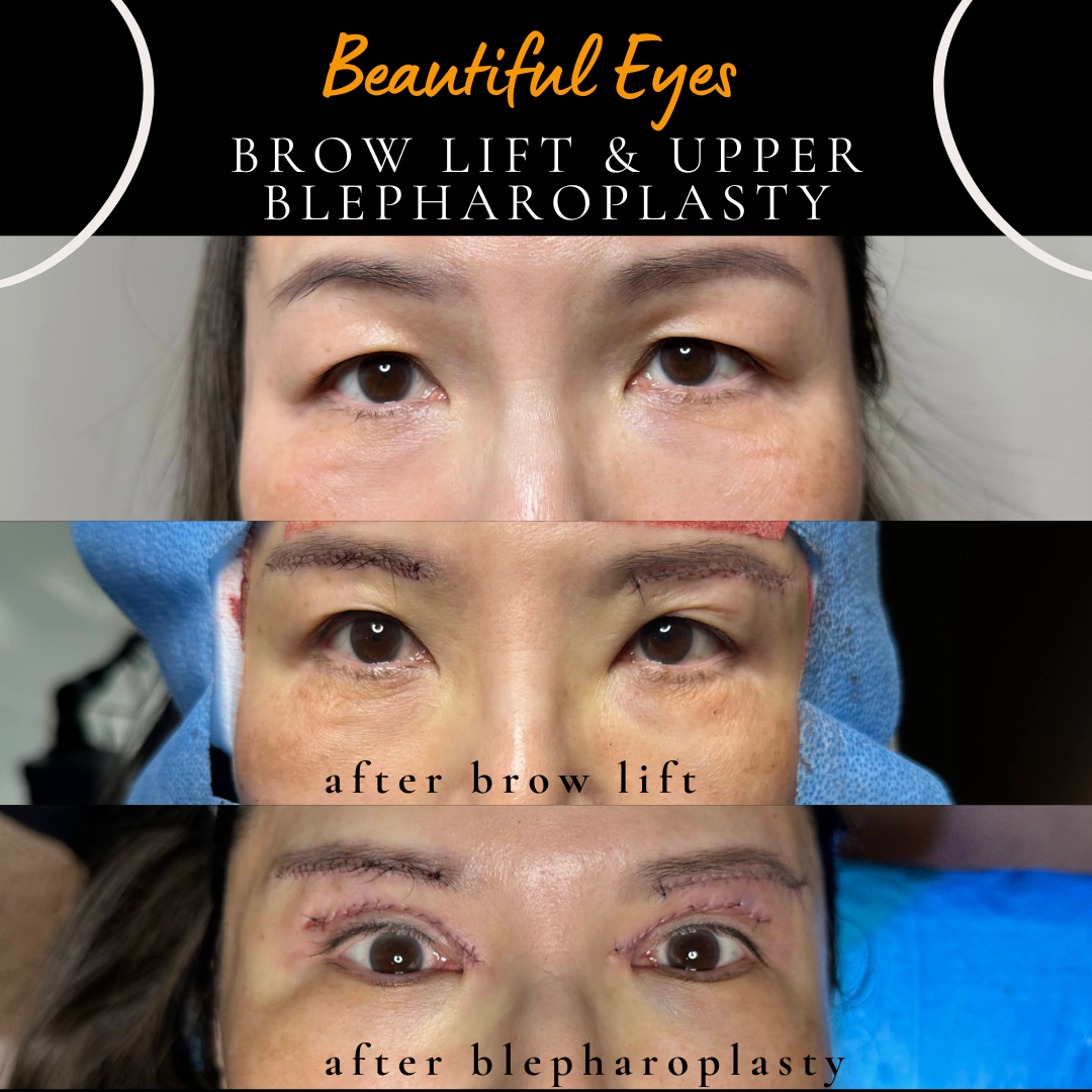 Close-up photo showing a patient's eyes after a combined subbrow lift and upper blepharoplasty by Cosmetic Eyelid Surgery, featuring a newly defined double eyelid fold and elevated brow line.