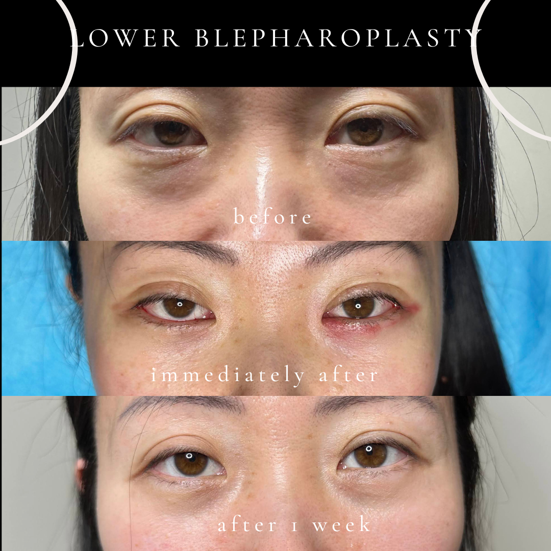 post operative progress photo after lower blepharoplasty to correct eyebags in young asian woman in sydney chatswood by dr peter kim