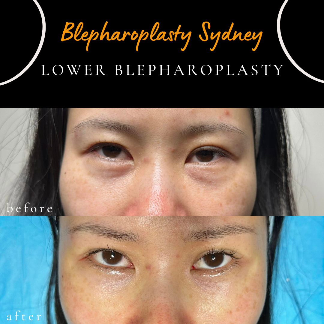 Before and after laser-assisted lower blepharoplasty for puffy lower eyelids and eye bags in a young Asian patient.