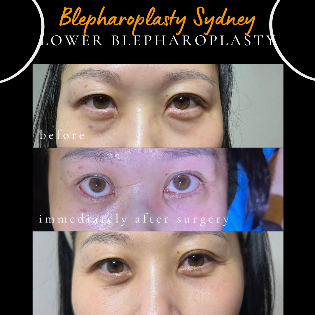 Before, immediately after, and four weeks after laser-assisted scarless lower blepharoplasty for hereditary eye bags in a young patient.