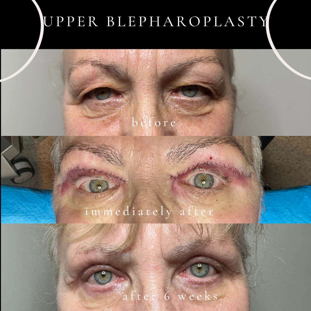 Before, immediately after, and six weeks after upper blepharoplasty performed under local anaesthesia by Dr Peter Kim, showing improved upper eyelid contour with mild residual swelling during healing.