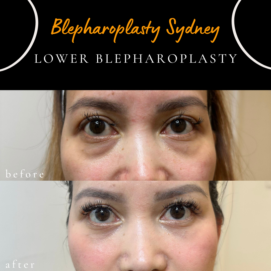 before after eyebag correction surgery sydney dr peter kim