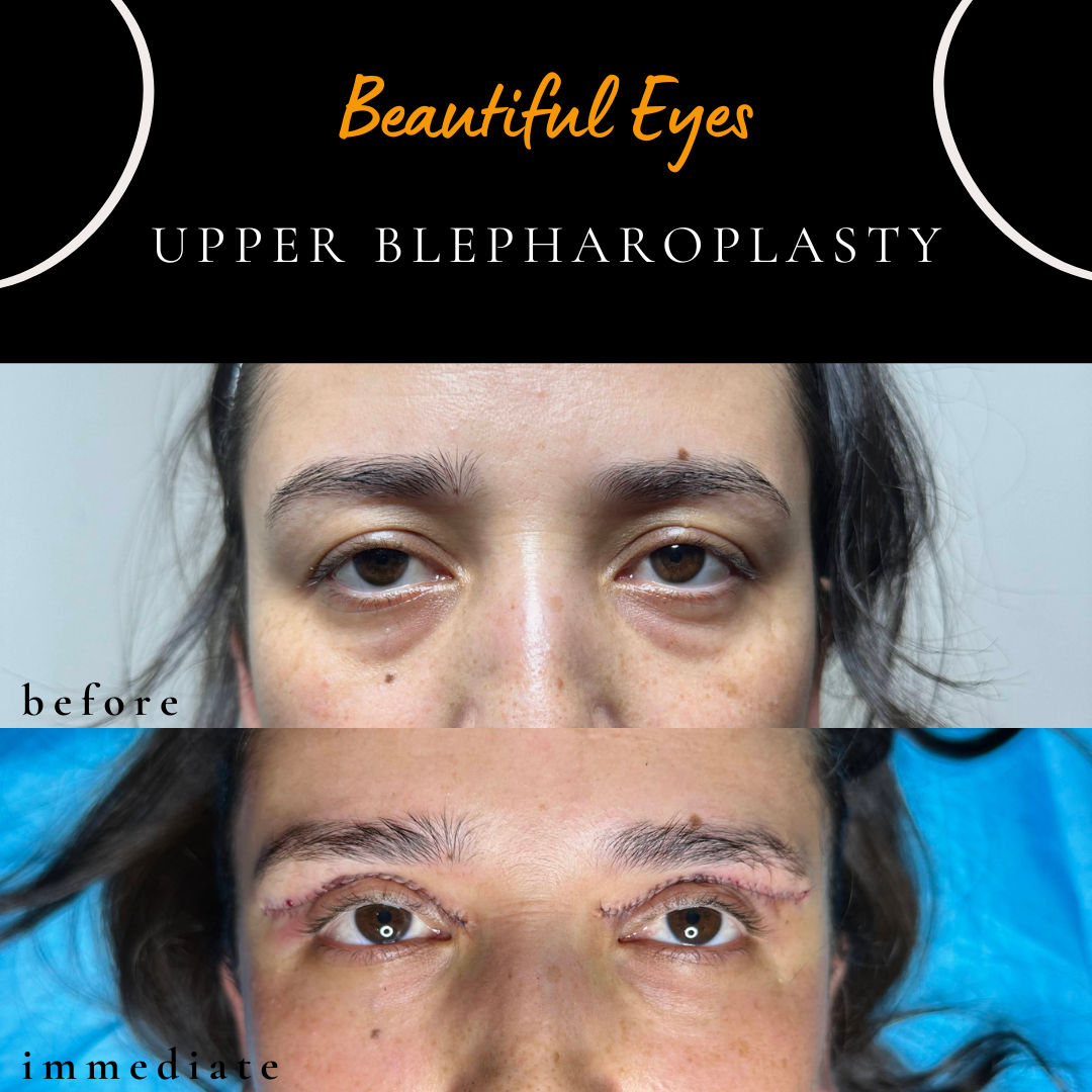Immediately after upper blepharoplasty showing improved upper eyelid contour following eyelid lift surgery performed under local anaesthesia by Dr Peter Kim.