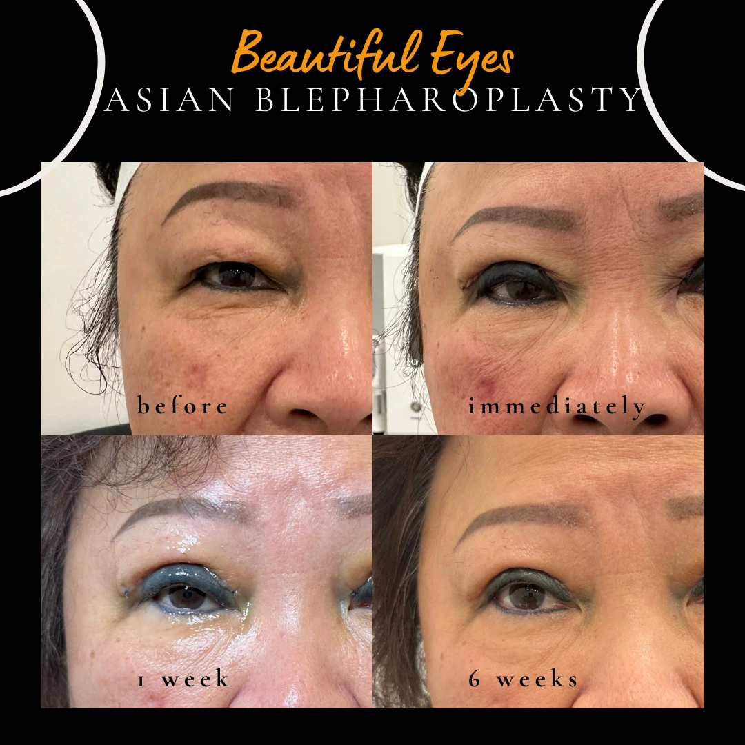 Asian blepharoplasty recovery by Dr Peter Kim in Sydney: before, immediately after, after 1 week and after 6 weeks.