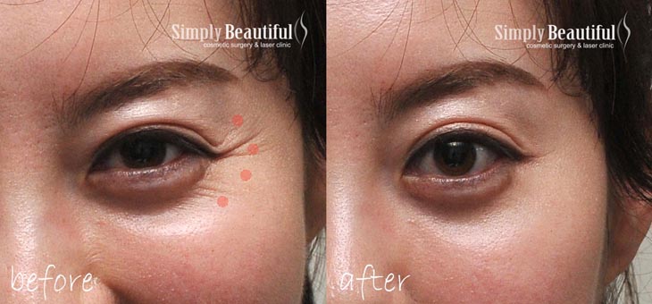 Before and after treatment of dynamic wrinkles in the crow&rsquo;s feet and lower eyelid area with cosmetic injections by Dr Peter Kim in Sydney.