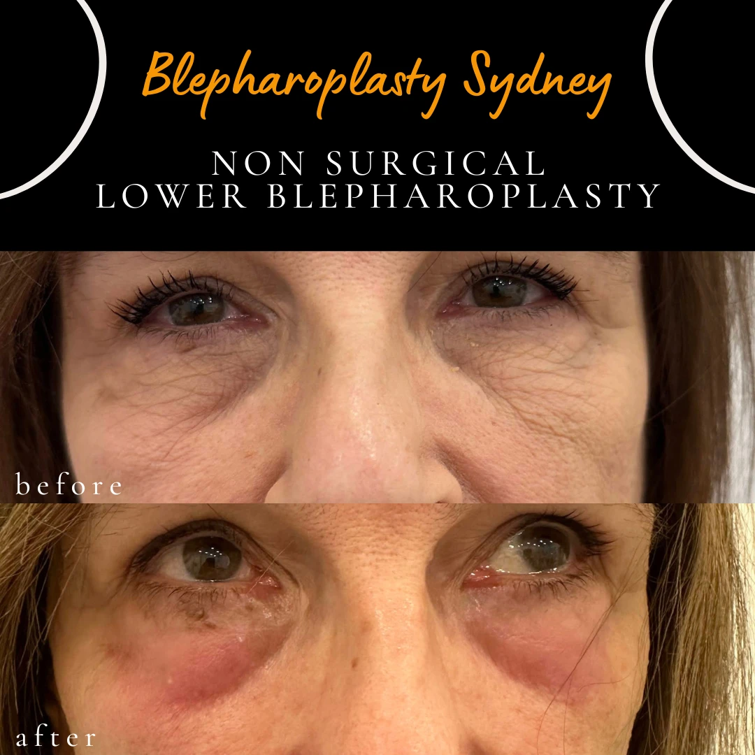 Before and after non-surgical laser resurfacing of the lower eyelid skin to improve wrinkles and skin tightness, by Dr Peter Kim in Sydney.