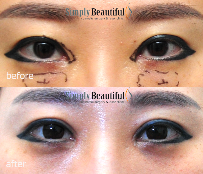 Before and after Mongolian fold surgery (medial epicanthoplasty) by Dr Peter Kim in Sydney, with the small Mongolian fold marked before surgery.