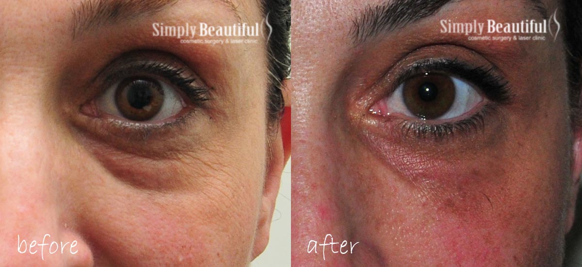 Before and after treatment of a tear trough deformity, filling the hollowness in the lower eyelid area, by Dr Peter Kim in Sydney.